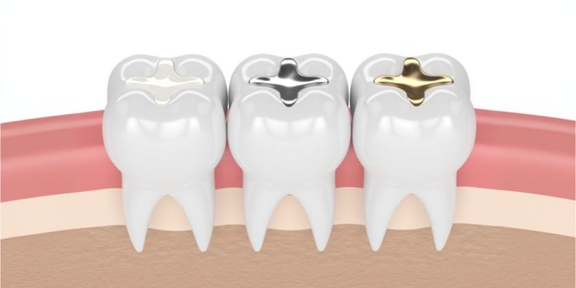What Are the Different Types of Dental Fillings